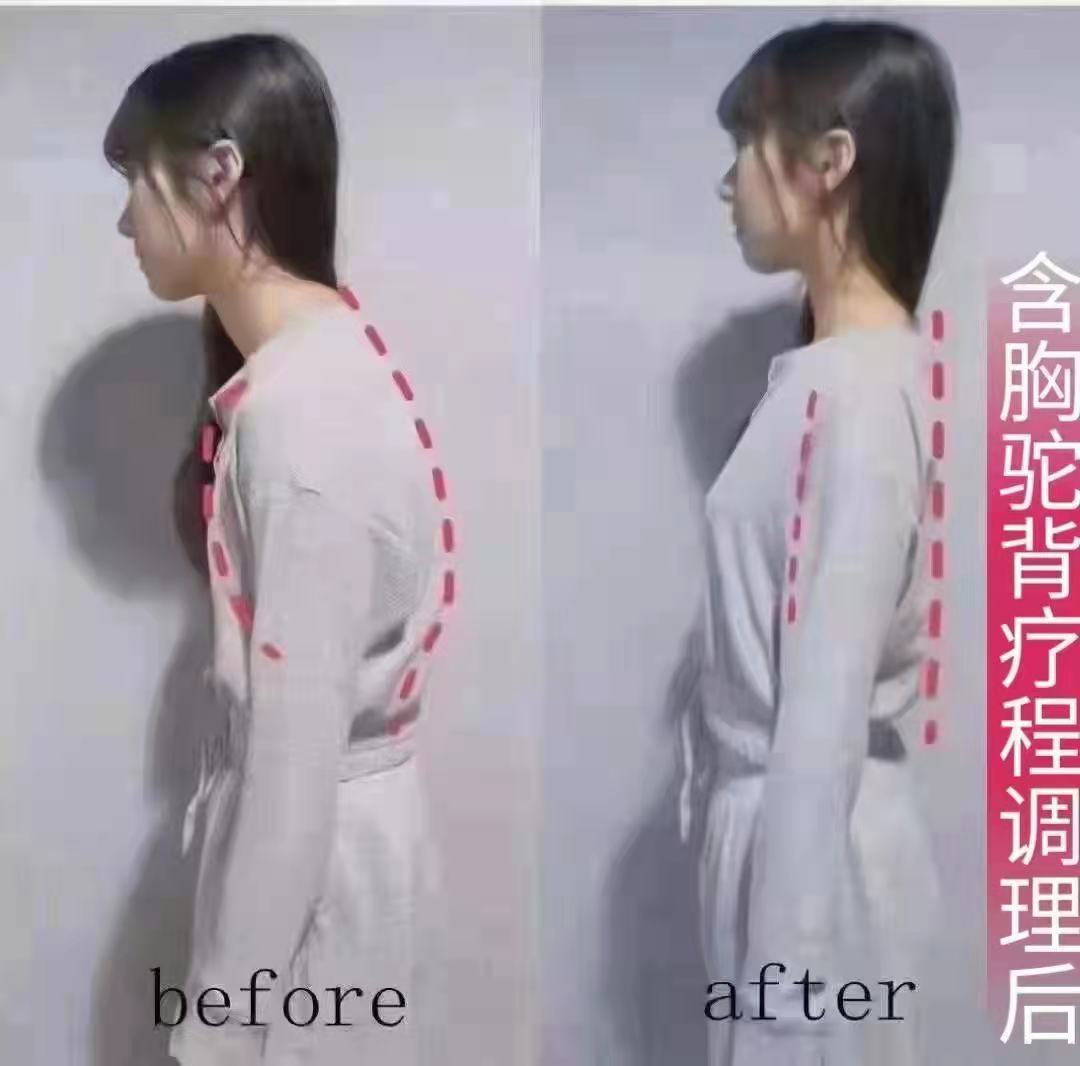驼背矫正